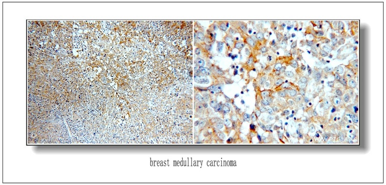 Immunohistochemistry (IHC) staining of Breast Cancer slides using HER2/ErbB2 Polyclonal antibody (51105-1-AP)