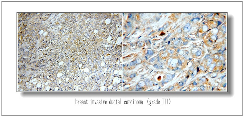 Immunohistochemistry (IHC) staining of Breast Cancer slides using HER2/ErbB2 Polyclonal antibody (51105-1-AP)
