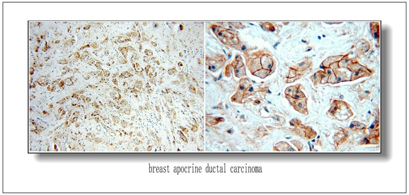 IHC staining of Breast Cancer slides using 51105-1-AP