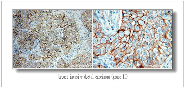 Immunohistochemistry (IHC) staining of Breast Cancer slides using HER2/ErbB2 Polyclonal antibody (51105-1-AP)