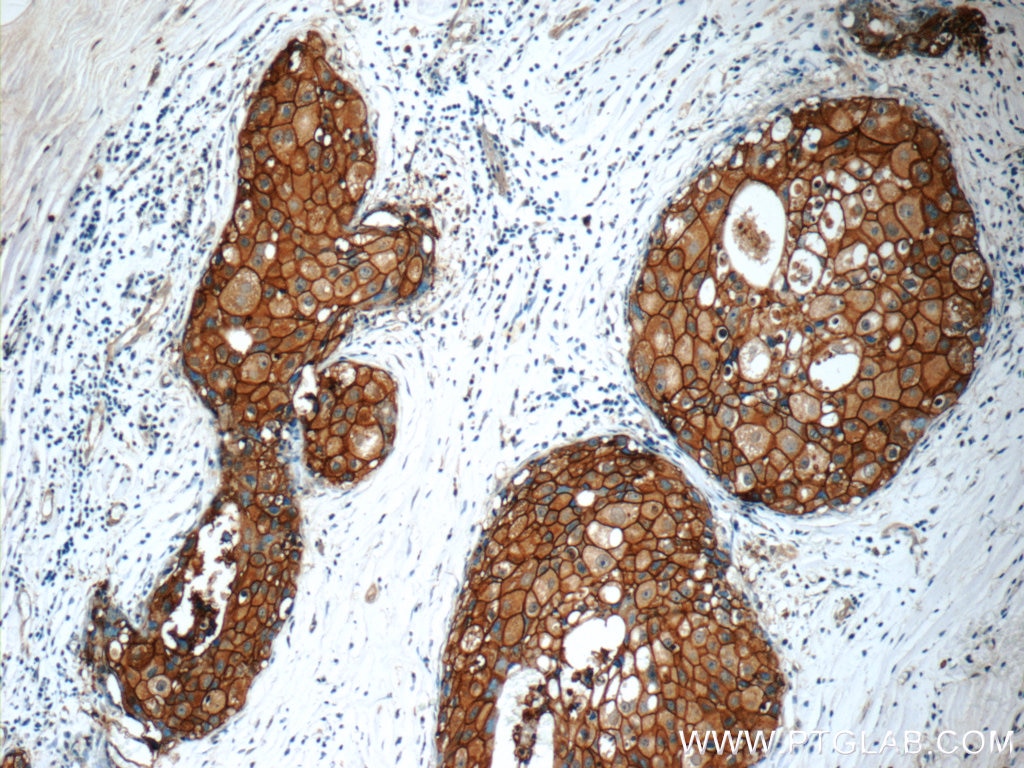 Immunohistochemistry (IHC) staining of human breast cancer tissue using HER2/ErbB2 Polyclonal antibody (51105-1-AP)