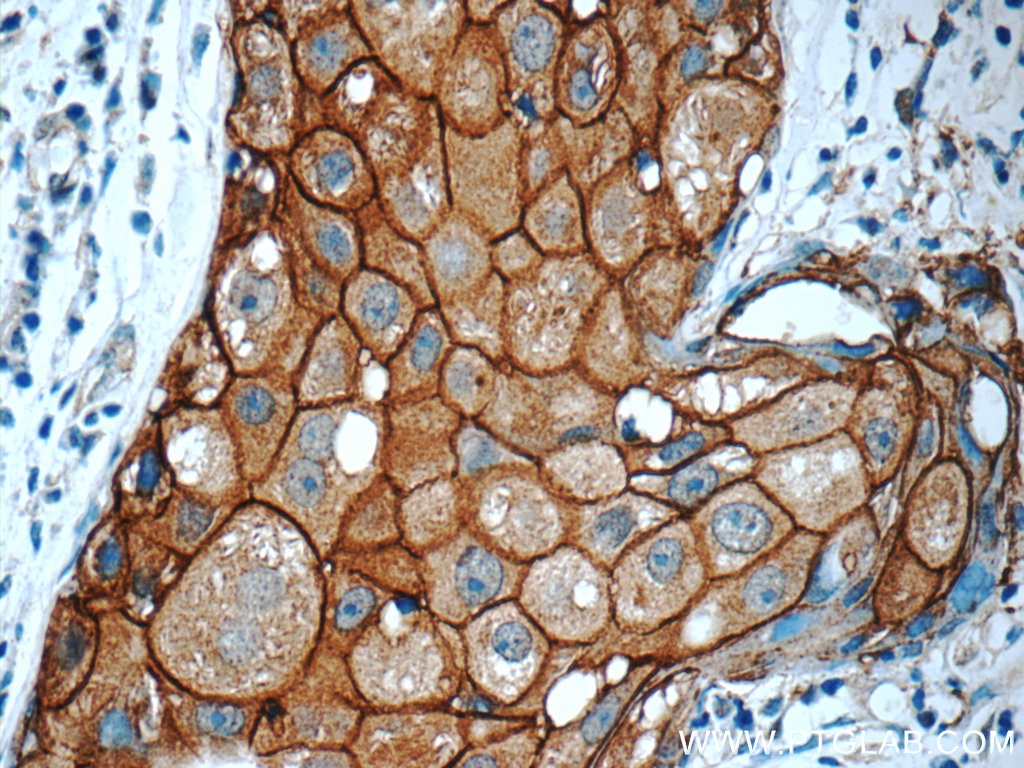 IHC staining of human breast cancer using 51105-1-AP