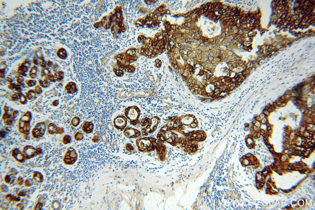 Immunohistochemistry (IHC) staining of human breast cancer tissue using HER2/ErbB2 Polyclonal antibody (51105-1-AP)