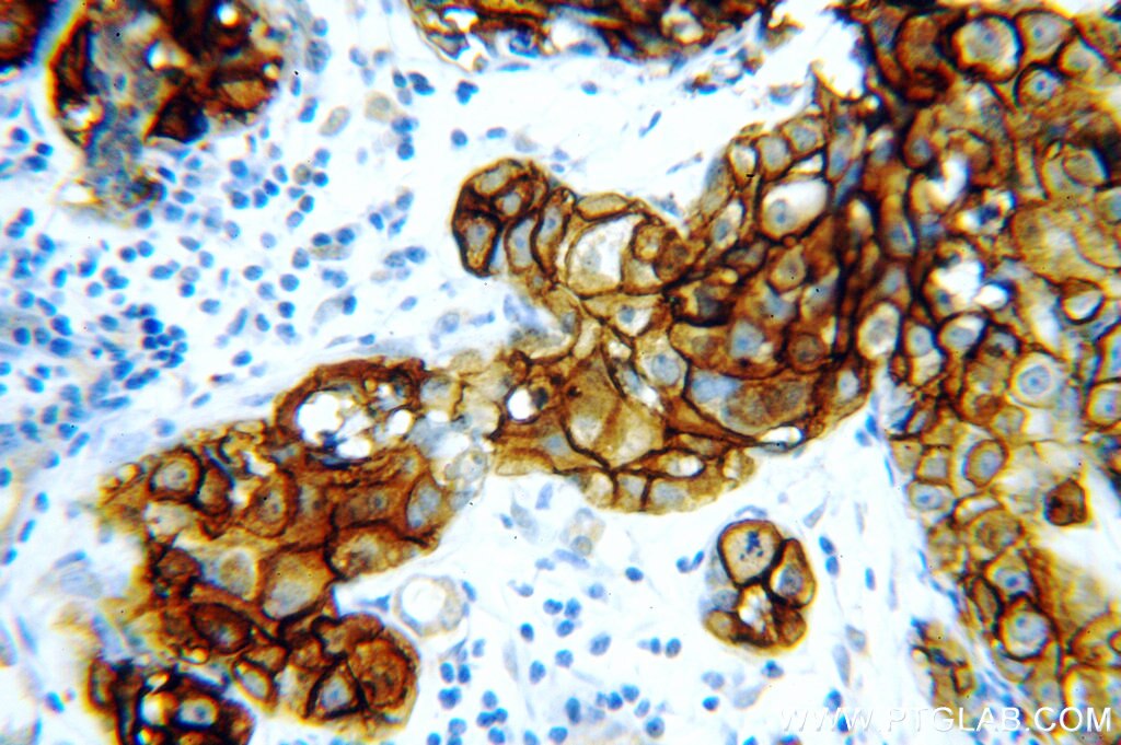 Immunohistochemistry (IHC) staining of human breast cancer tissue using HER2/ErbB2 Polyclonal antibody (51105-1-AP)