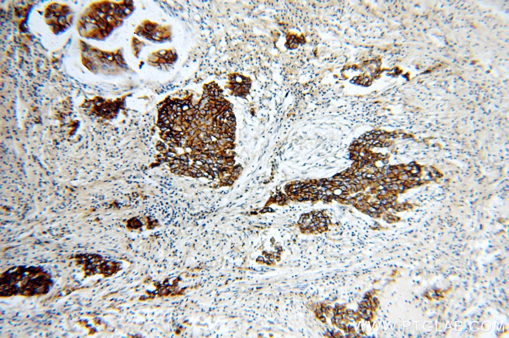 Immunohistochemistry (IHC) staining of human breast cancer tissue using HER2/ErbB2 Polyclonal antibody (51105-1-AP)