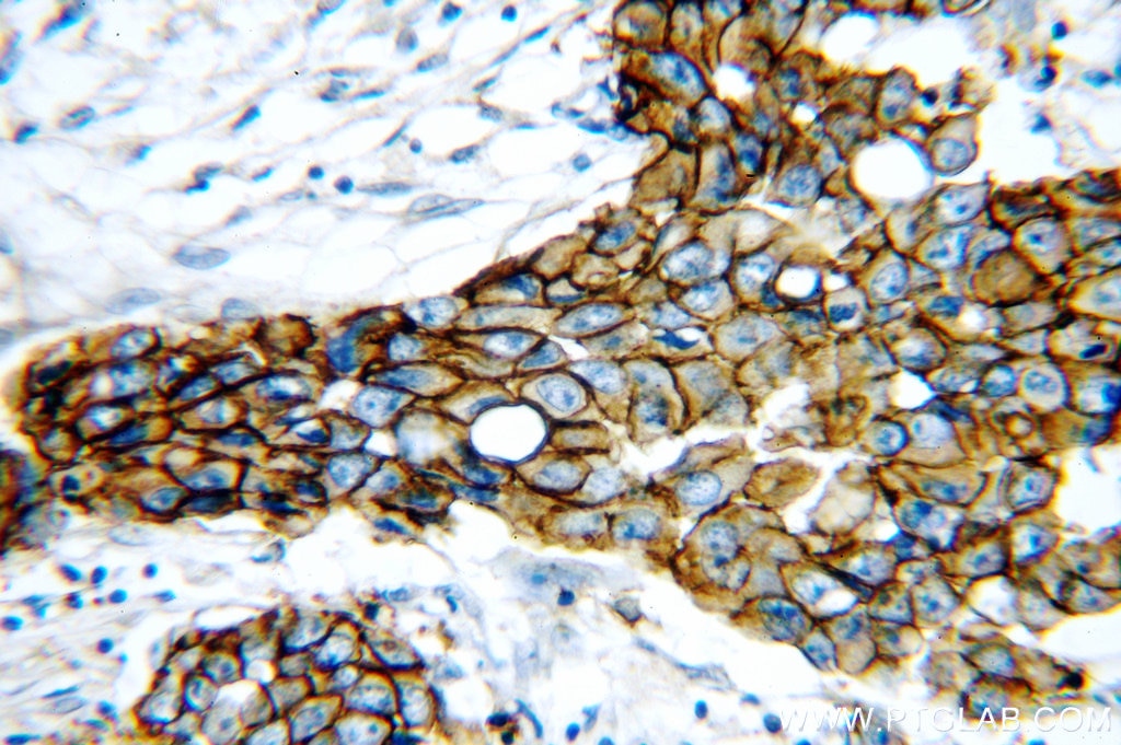 Immunohistochemistry (IHC) staining of human breast cancer tissue using HER2/ErbB2 Polyclonal antibody (51105-1-AP)