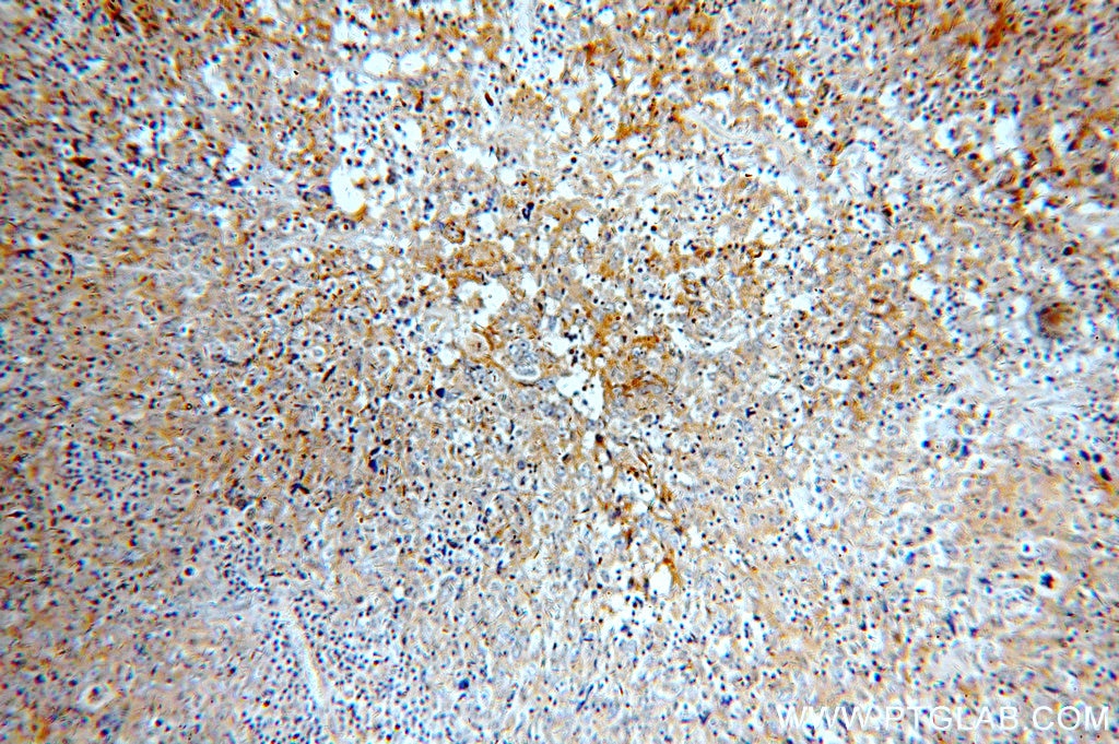 Immunohistochemistry (IHC) staining of human breast cancer tissue using HER2/ErbB2 Polyclonal antibody (51105-1-AP)