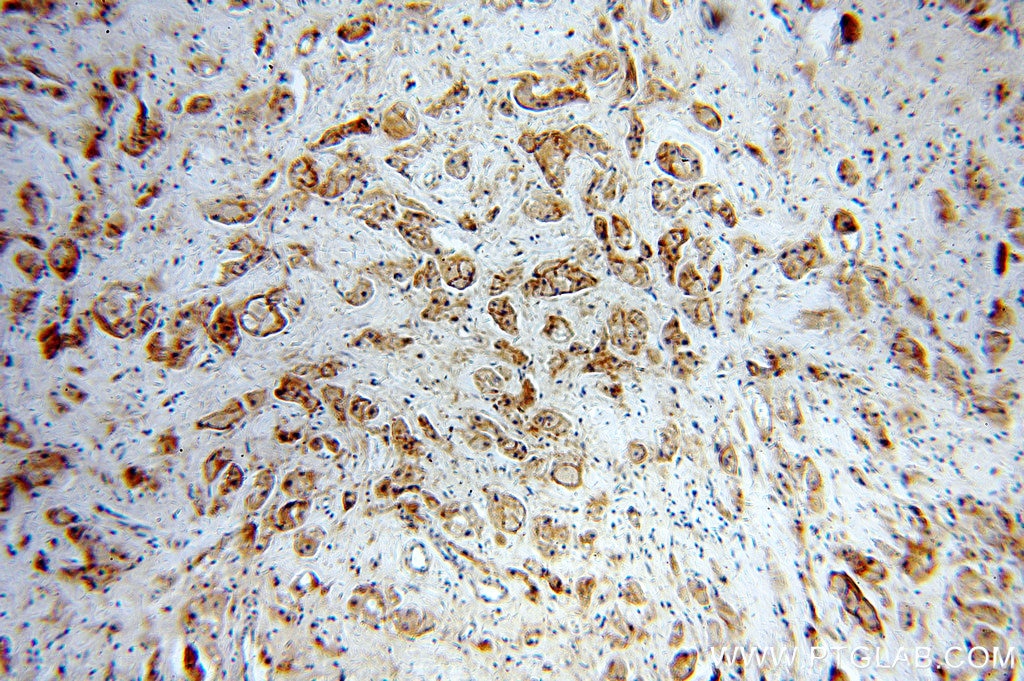 Immunohistochemistry (IHC) staining of human breast cancer tissue using HER2/ErbB2 Polyclonal antibody (51105-1-AP)