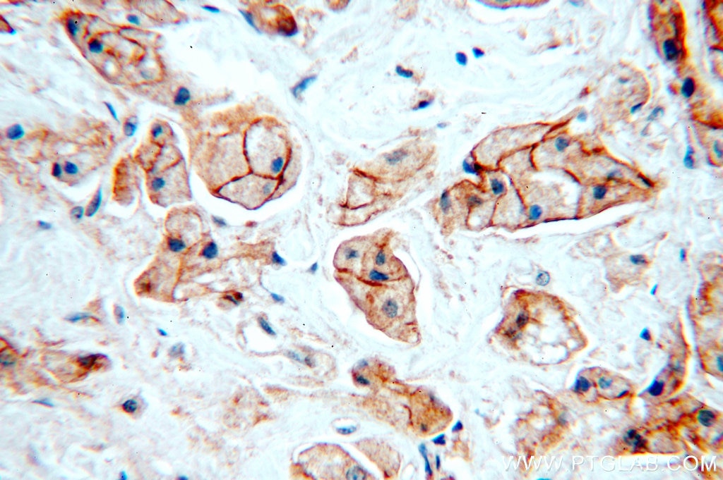 Immunohistochemistry (IHC) staining of human breast cancer tissue using HER2/ErbB2 Polyclonal antibody (51105-1-AP)