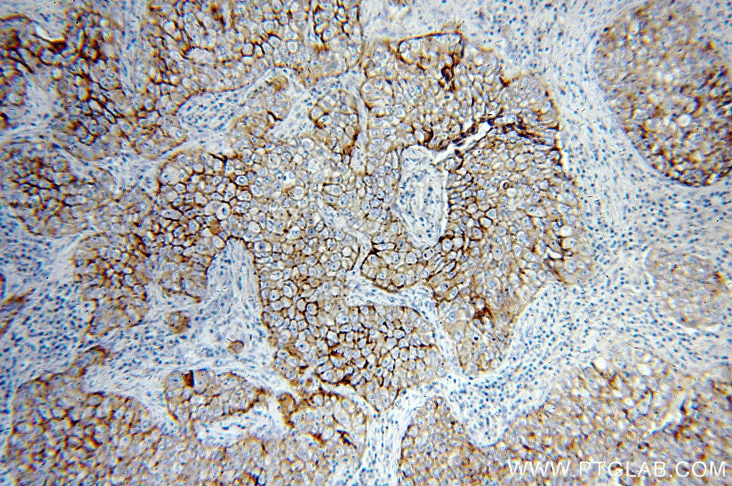 IHC staining of human breast cancer using 51105-1-AP