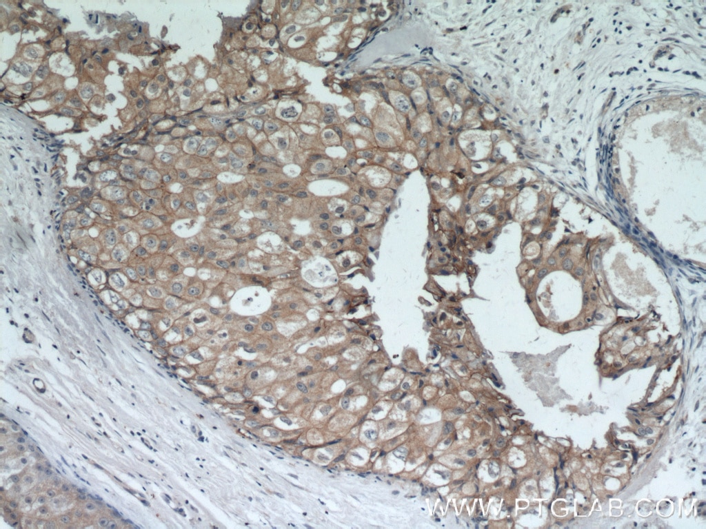 IHC staining of human breast cancer using 51105-1-AP