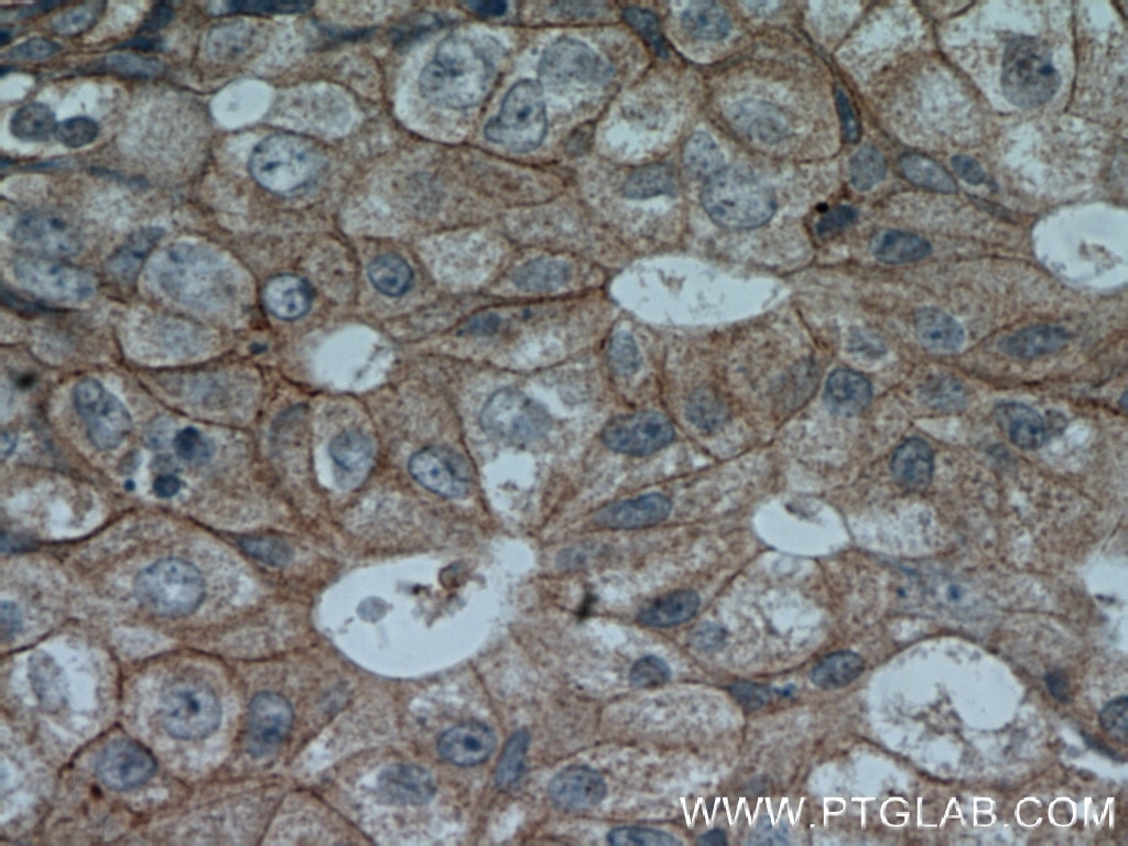 Immunohistochemistry (IHC) staining of human breast cancer tissue using HER2/ErbB2 Polyclonal antibody (51105-1-AP)