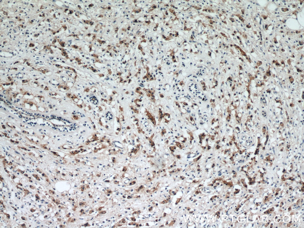 Immunohistochemistry (IHC) staining of human breast cancer tissue using HER2/ErbB2 Polyclonal antibody (51105-1-AP)
