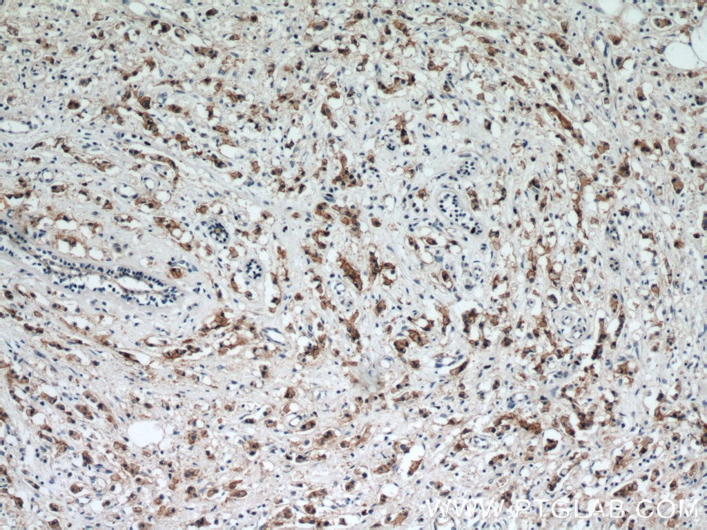 IHC staining of human breast cancer using 51105-1-AP