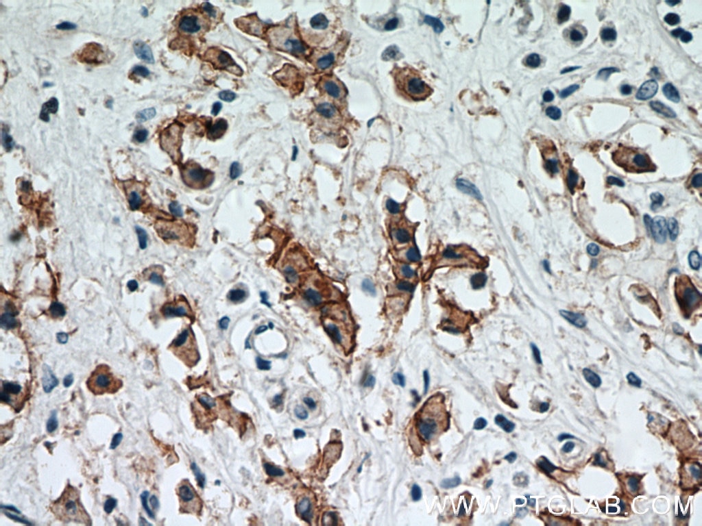 Immunohistochemistry (IHC) staining of human breast cancer tissue using HER2/ErbB2 Polyclonal antibody (51105-1-AP)