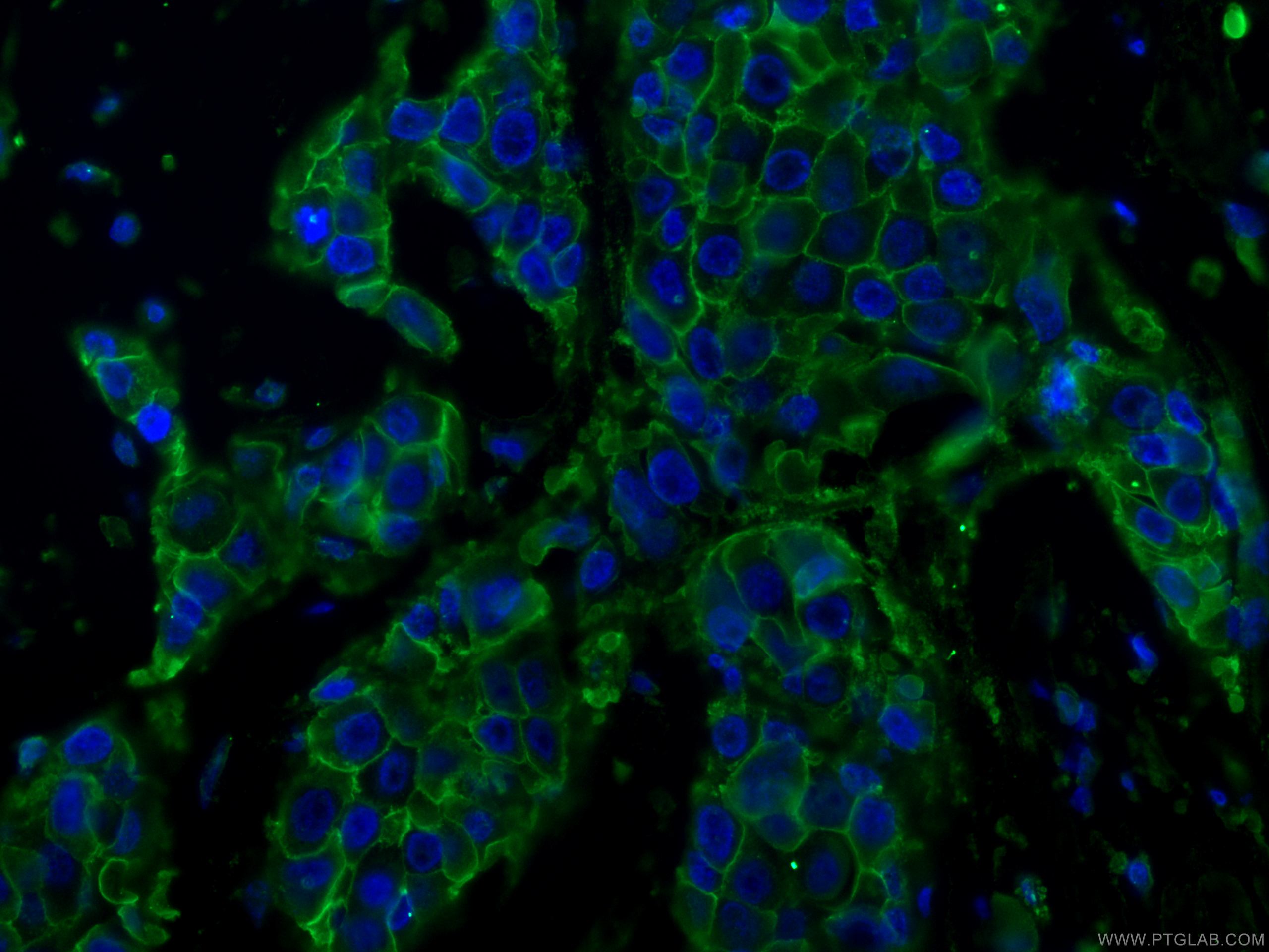 Immunofluorescence (IF) / fluorescent staining of human breast cancer tissue using HER2/ErbB2 Monoclonal antibody (60311-1-Ig)