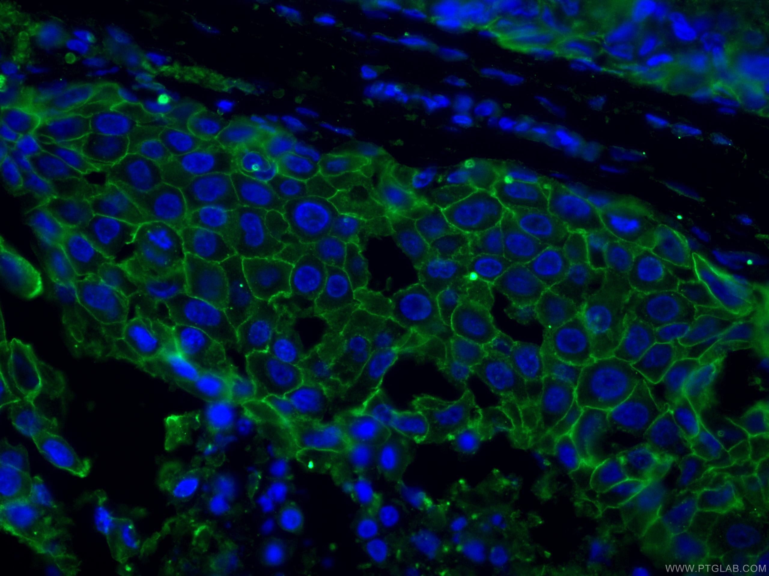 Immunofluorescence (IF) / fluorescent staining of human breast cancer tissue using HER2/ErbB2 Monoclonal antibody (60311-1-Ig)