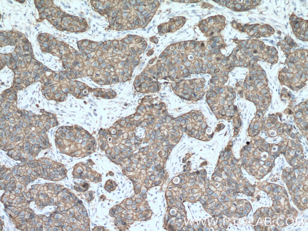 Immunohistochemistry (IHC) staining of human breast cancer tissue using HER2/ErbB2 Monoclonal antibody (60311-1-Ig)