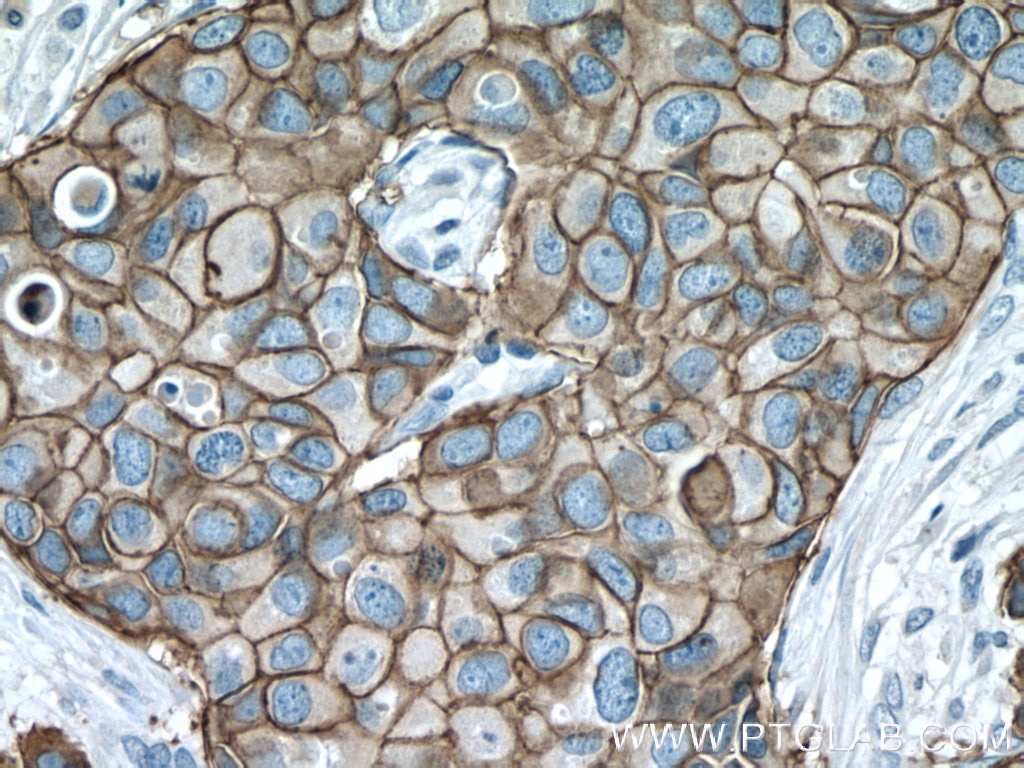 Immunohistochemistry (IHC) staining of human breast cancer tissue using HER2/ErbB2 Monoclonal antibody (60311-1-Ig)