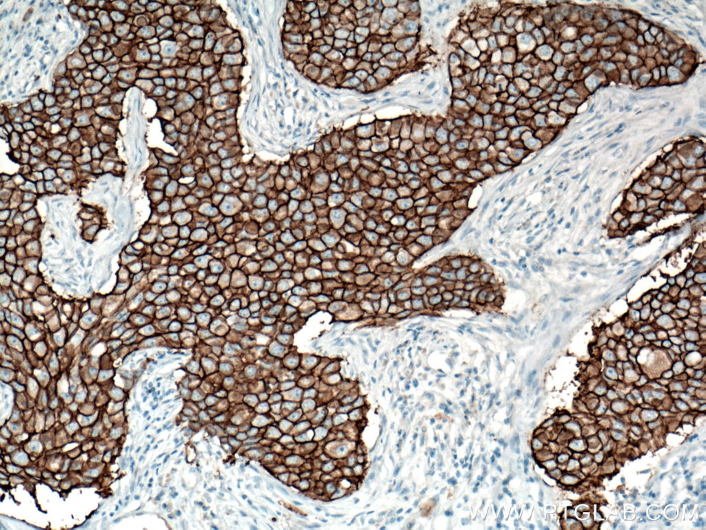 Immunohistochemistry (IHC) staining of human breast cancer tissue using HER2/ErbB2 Monoclonal antibody (60311-1-Ig)