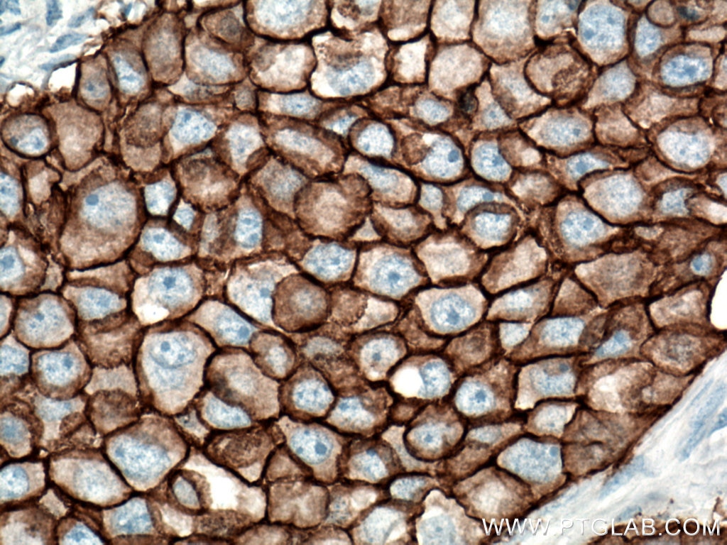 Immunohistochemistry (IHC) staining of human breast cancer tissue using HER2/ErbB2 Monoclonal antibody (60311-1-Ig)