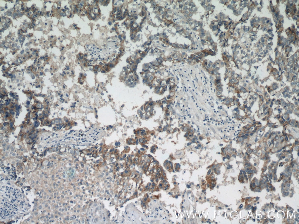 Immunohistochemistry (IHC) staining of human breast cancer tissue using HER2/ErbB2 Monoclonal antibody (60311-1-Ig)