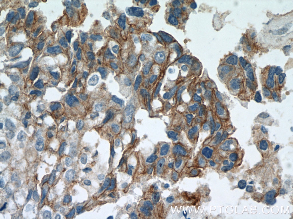 Immunohistochemistry (IHC) staining of human breast cancer tissue using HER2/ErbB2 Monoclonal antibody (60311-1-Ig)