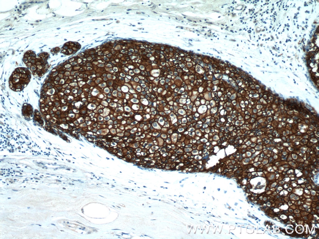 IHC staining of human breast cancer using 60311-1-Ig