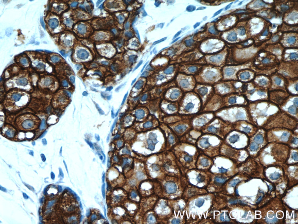 Immunohistochemistry (IHC) staining of human breast cancer tissue using HER2/ErbB2 Monoclonal antibody (60311-1-Ig)