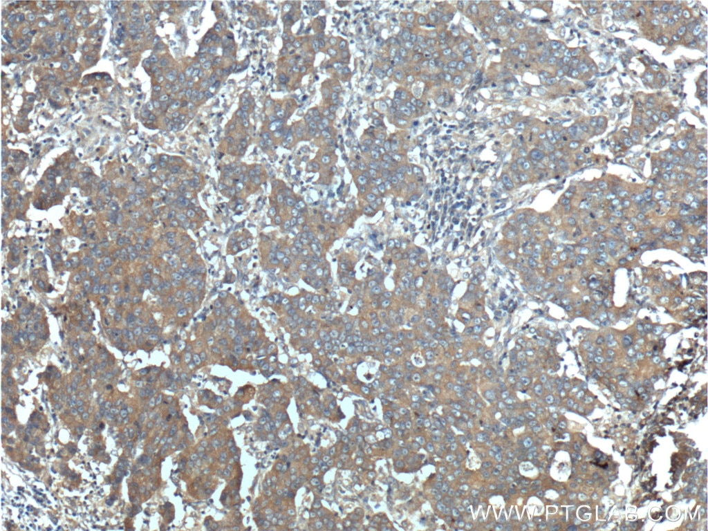 Immunohistochemistry (IHC) staining of human prostate cancer tissue using ERBB3 Polyclonal antibody (10369-1-AP)