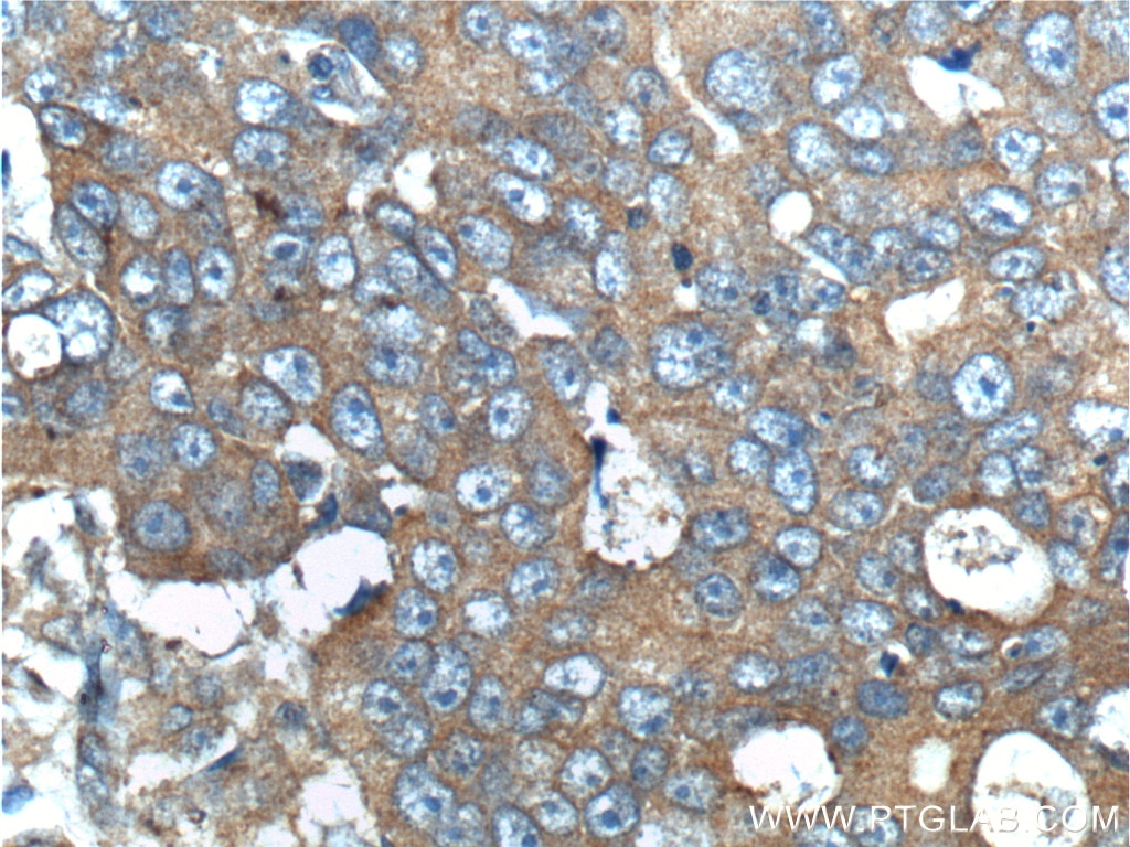 Immunohistochemistry (IHC) staining of human prostate cancer tissue using ERBB3 Polyclonal antibody (10369-1-AP)