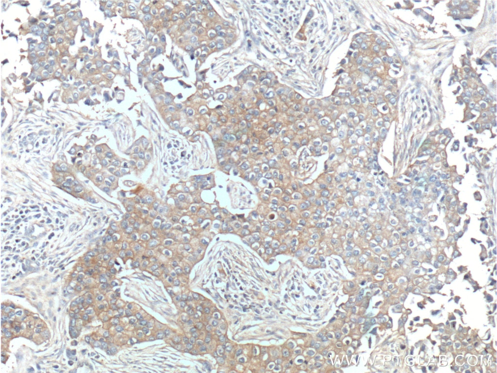 Immunohistochemistry (IHC) staining of human breast cancer tissue using ERBB3 Polyclonal antibody (10369-1-AP)