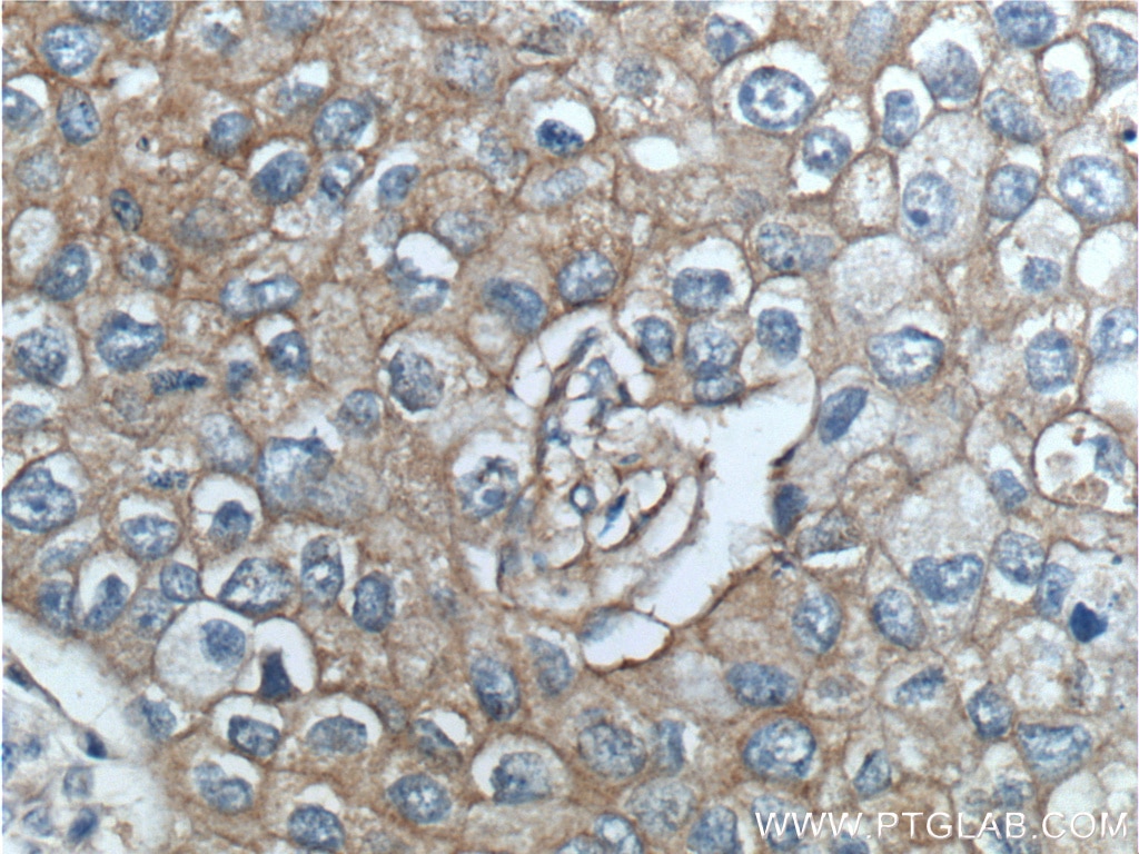 Immunohistochemistry (IHC) staining of human breast cancer tissue using ERBB3 Polyclonal antibody (10369-1-AP)
