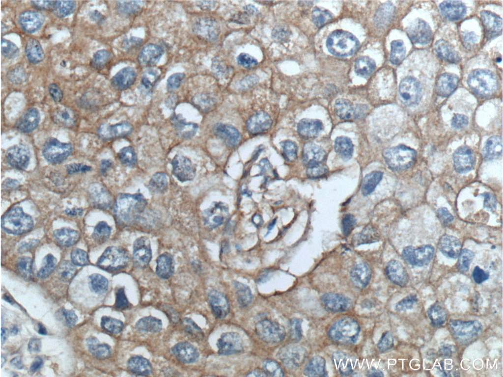 Immunohistochemistry (IHC) staining of human breast cancer tissue using ERBB3 Polyclonal antibody (10369-1-AP)