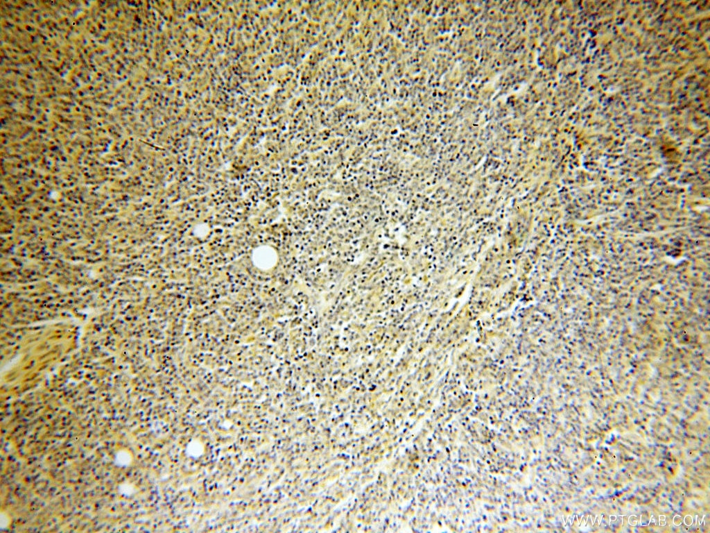 Immunohistochemistry (IHC) staining of human lymphoma tissue using ERCC2 Polyclonal antibody (10818-1-AP)