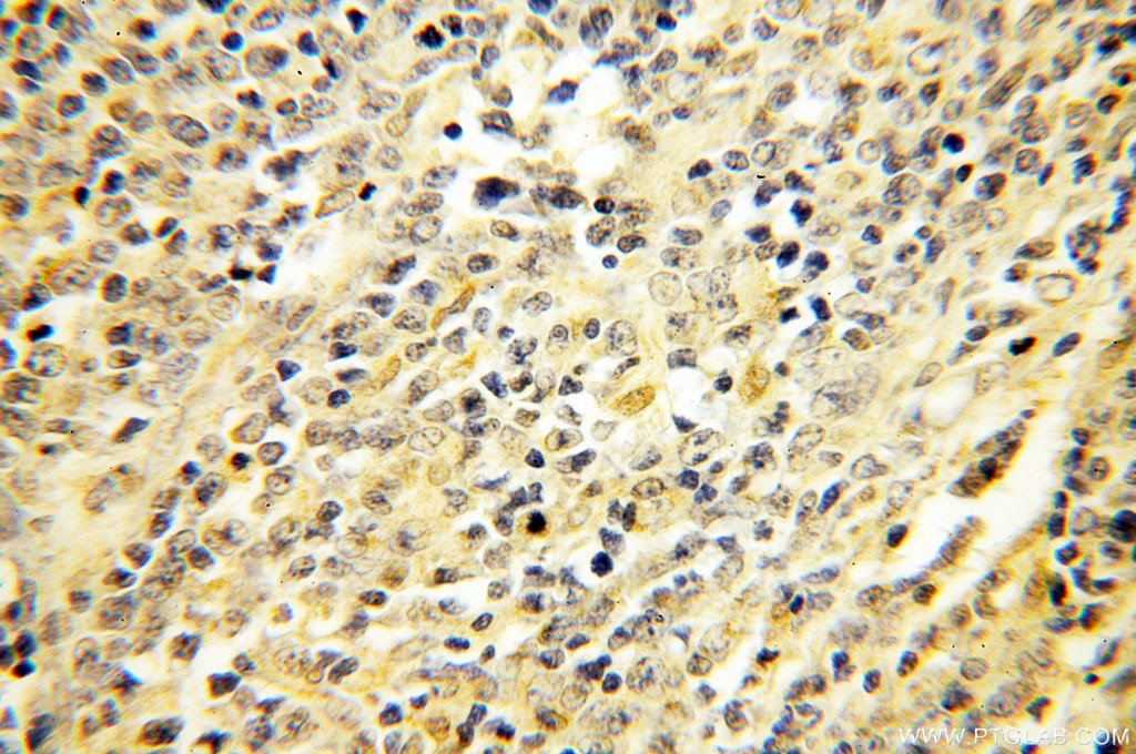 Immunohistochemistry (IHC) staining of human lymphoma tissue using ERCC2 Polyclonal antibody (10818-1-AP)