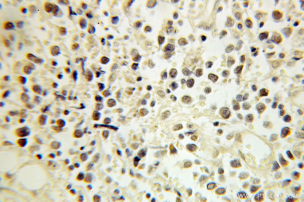 IHC staining of human lymphoma using 10818-1-AP