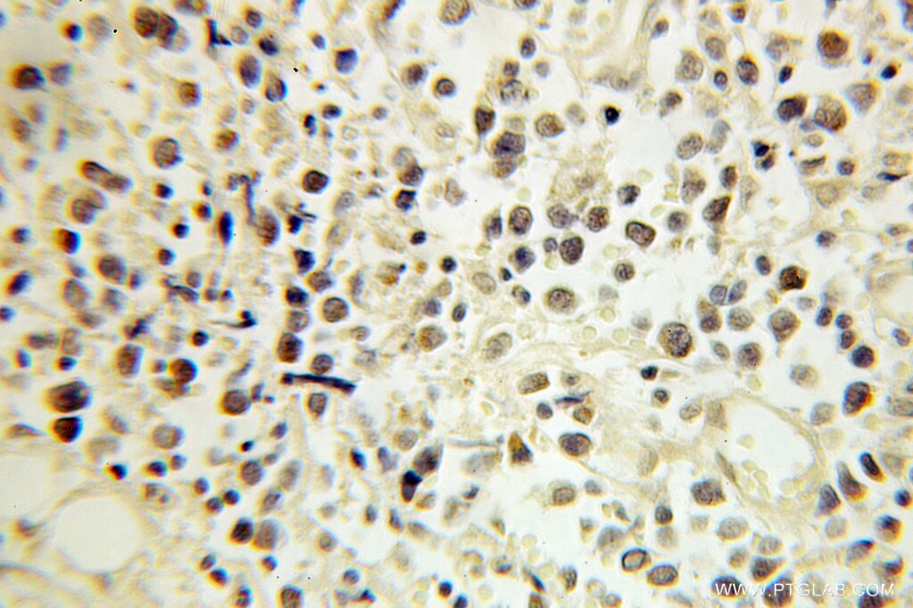 Immunohistochemistry (IHC) staining of human lymphoma tissue using ERCC2 Polyclonal antibody (10818-1-AP)