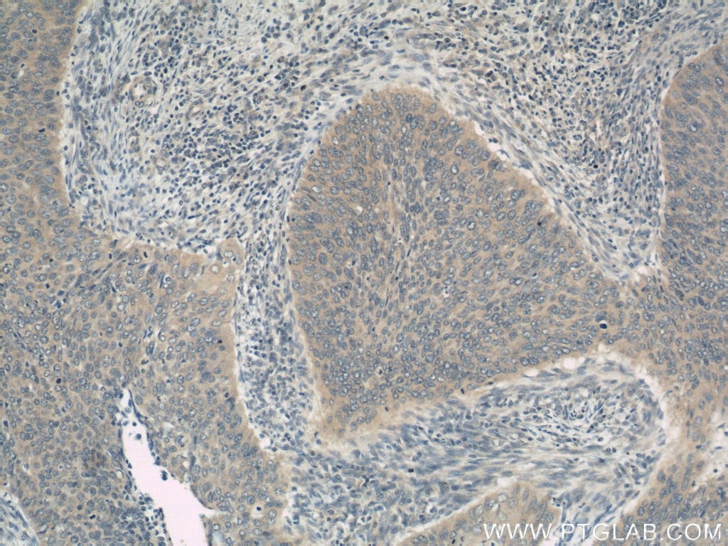 IHC staining of human cervical cancer using 10818-1-AP