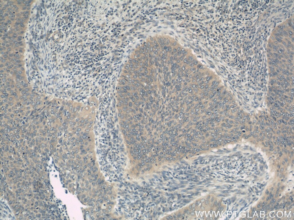 Immunohistochemistry (IHC) staining of human cervical cancer tissue using ERCC2 Polyclonal antibody (10818-1-AP)