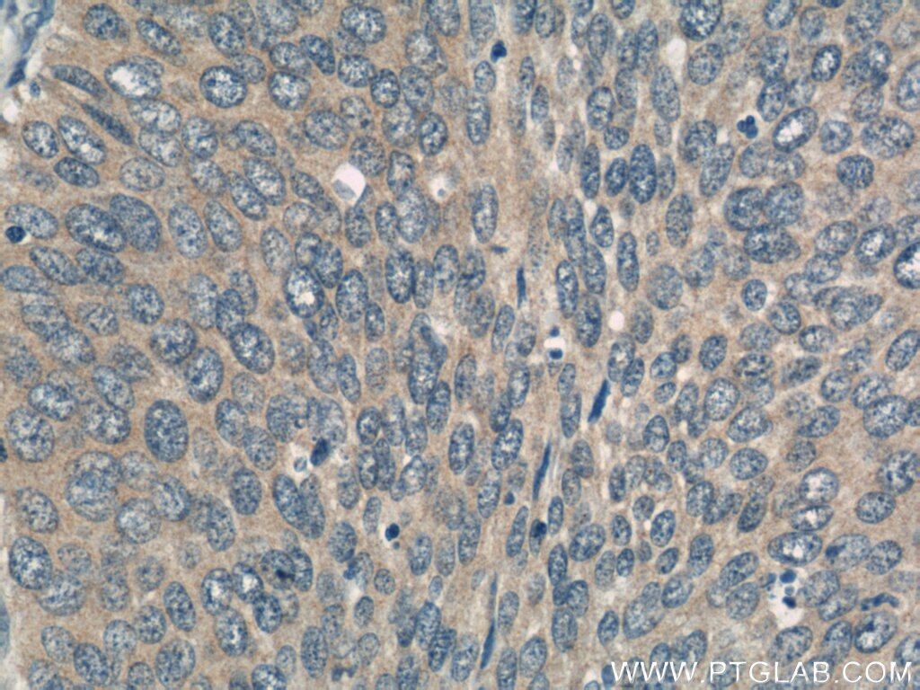 Immunohistochemistry (IHC) staining of human cervical cancer tissue using ERCC2 Polyclonal antibody (10818-1-AP)