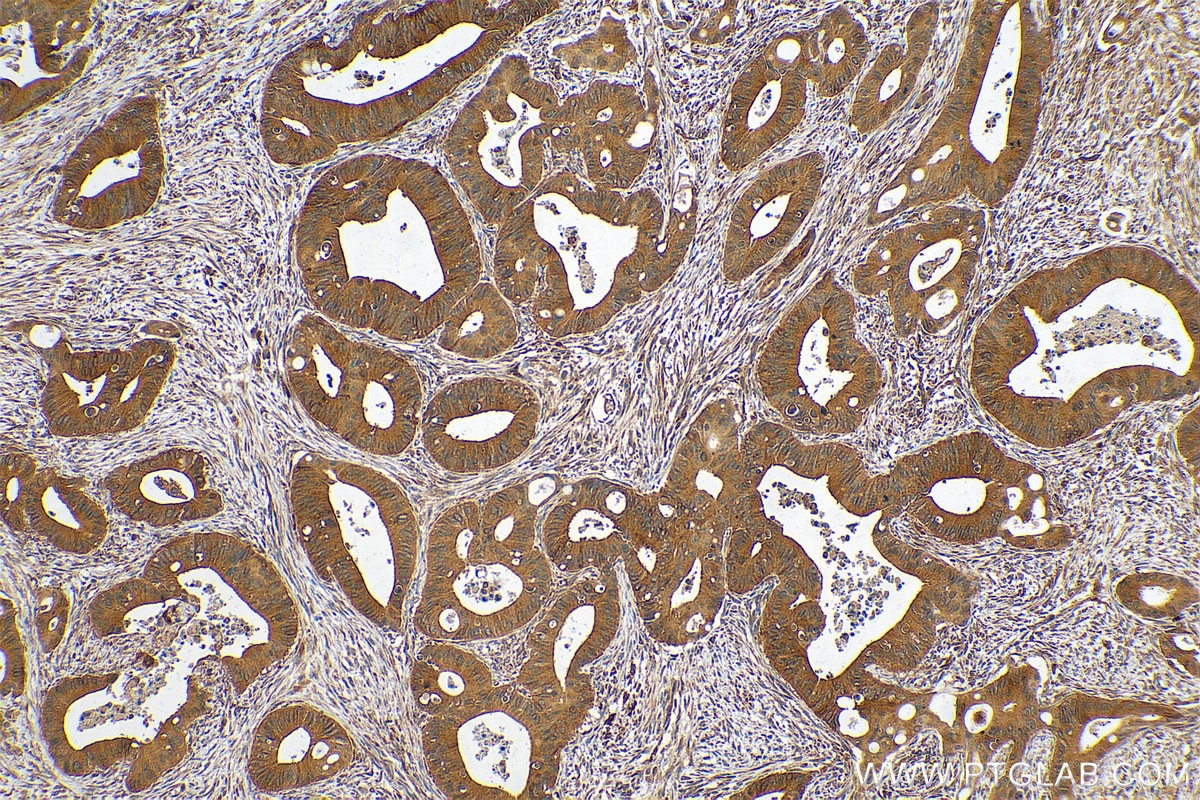 Immunohistochemistry (IHC) staining of human colon cancer tissue using ERCC6L Polyclonal antibody (15688-1-AP)