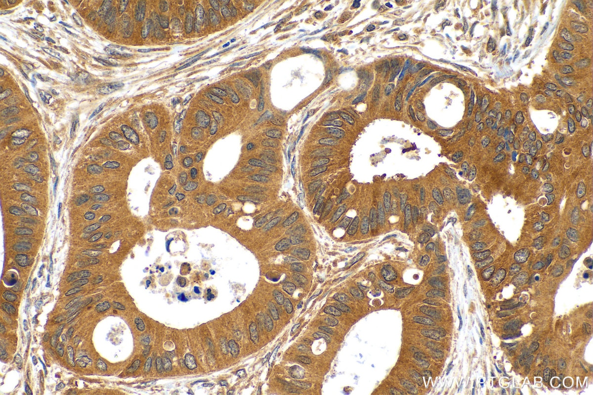 Immunohistochemistry (IHC) staining of human colon cancer tissue using ERCC6L Polyclonal antibody (15688-1-AP)