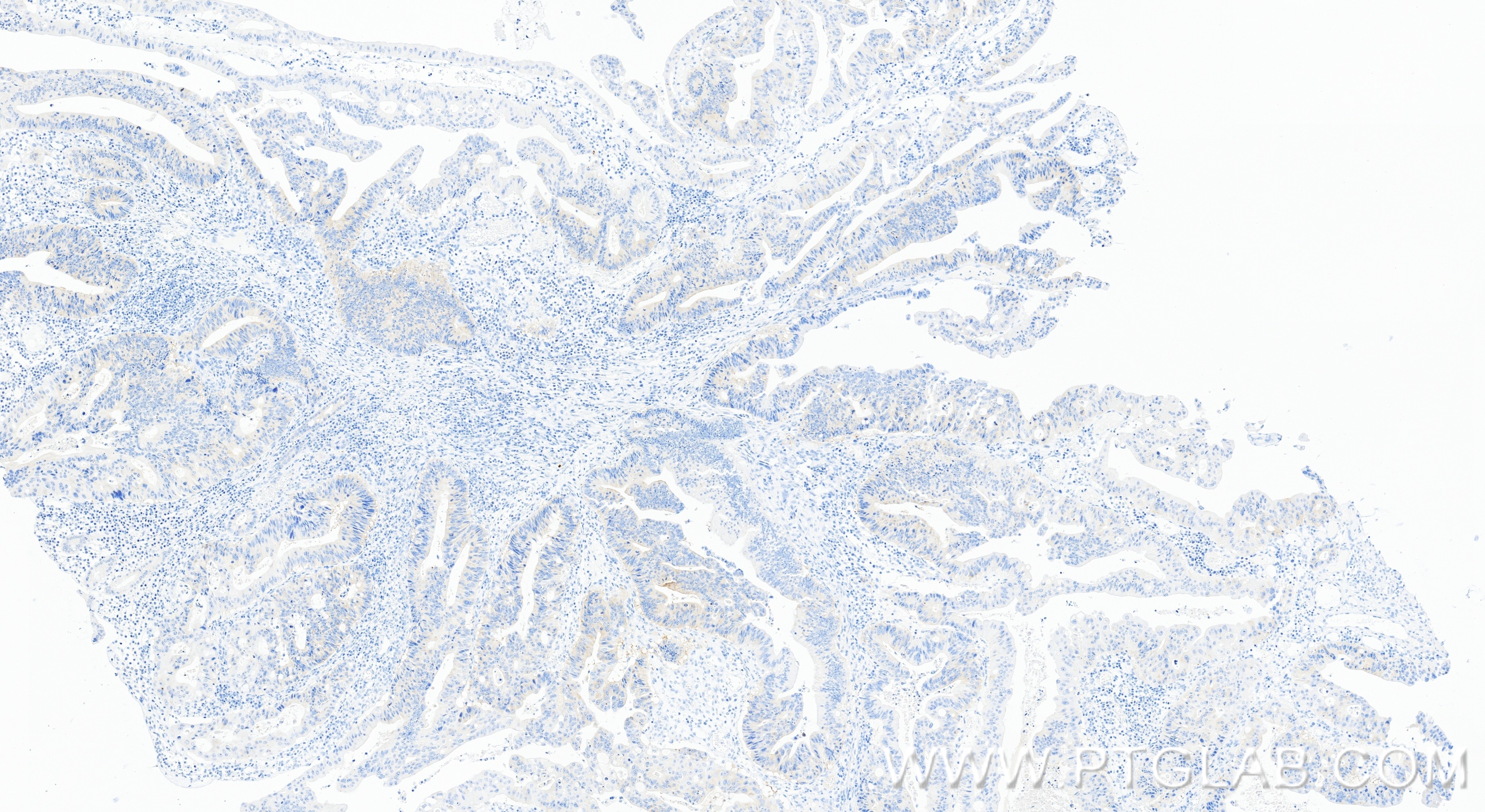 IHC staining of human colon cancer using 86688-1-RR (same clone as 86688-1-PBS) Immunohistochemistry (IHC) staining of human colon cancer tissue using ERCC6L Recombinant monoclonal antibody (86688-1-RR)