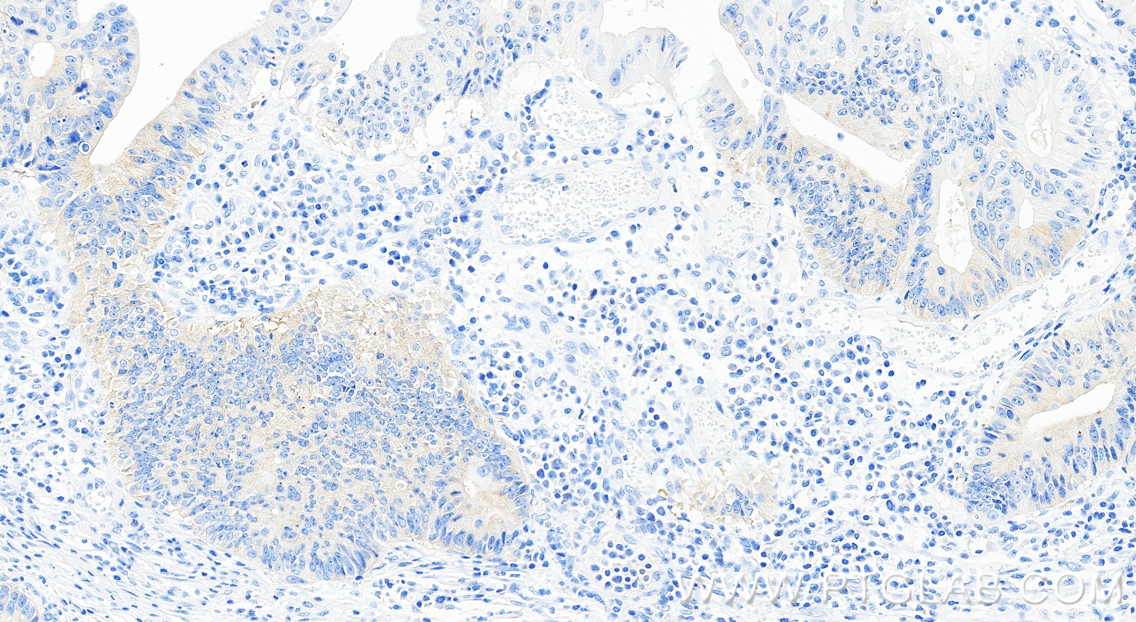 IHC staining of human colon cancer using 86688-1-RR (same clone as 86688-1-PBS) Immunohistochemistry (IHC) staining of human colon cancer tissue using ERCC6L Recombinant monoclonal antibody (86688-1-RR)