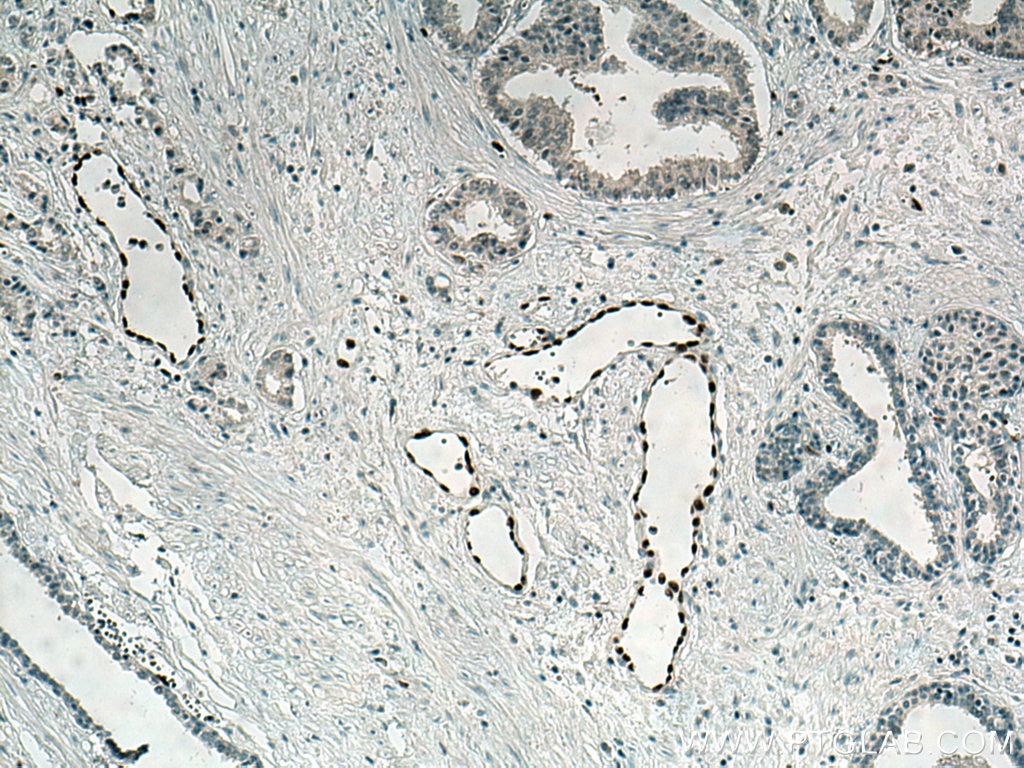 Immunohistochemistry (IHC) staining of human prostate cancer tissue using ERG Polyclonal antibody (14356-1-AP)