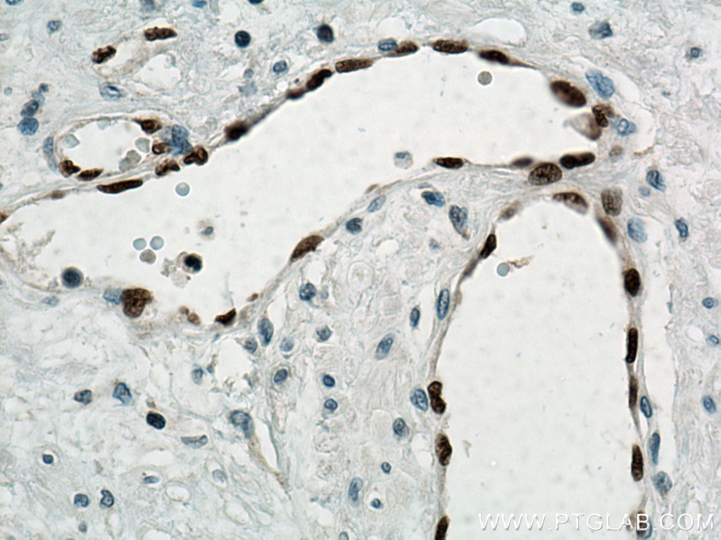 Immunohistochemistry (IHC) staining of human prostate cancer tissue using ERG Polyclonal antibody (14356-1-AP)