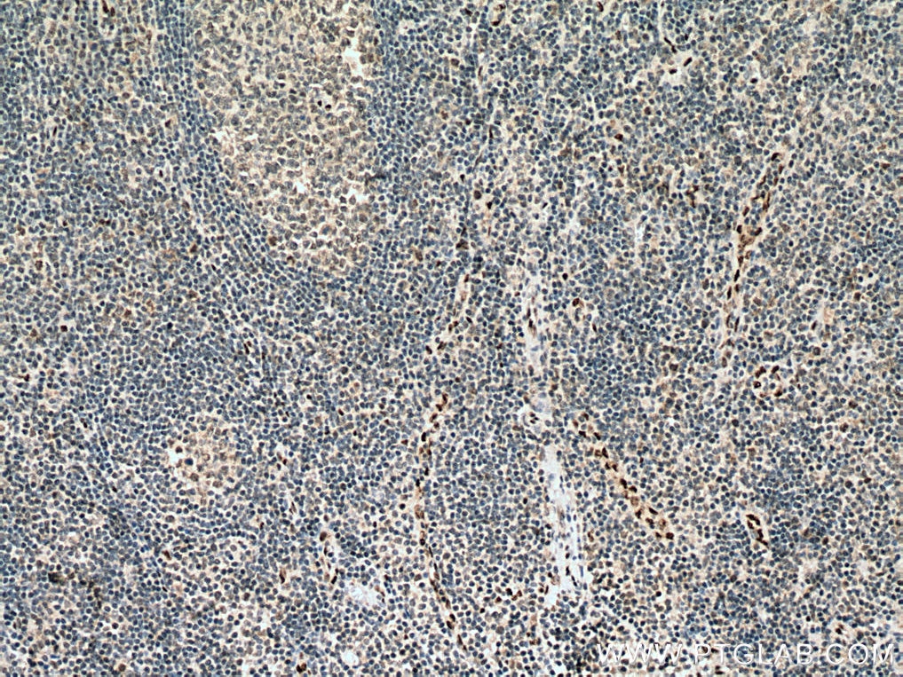 Immunohistochemistry (IHC) staining of human tonsillitis tissue using ERG Polyclonal antibody (14356-1-AP)