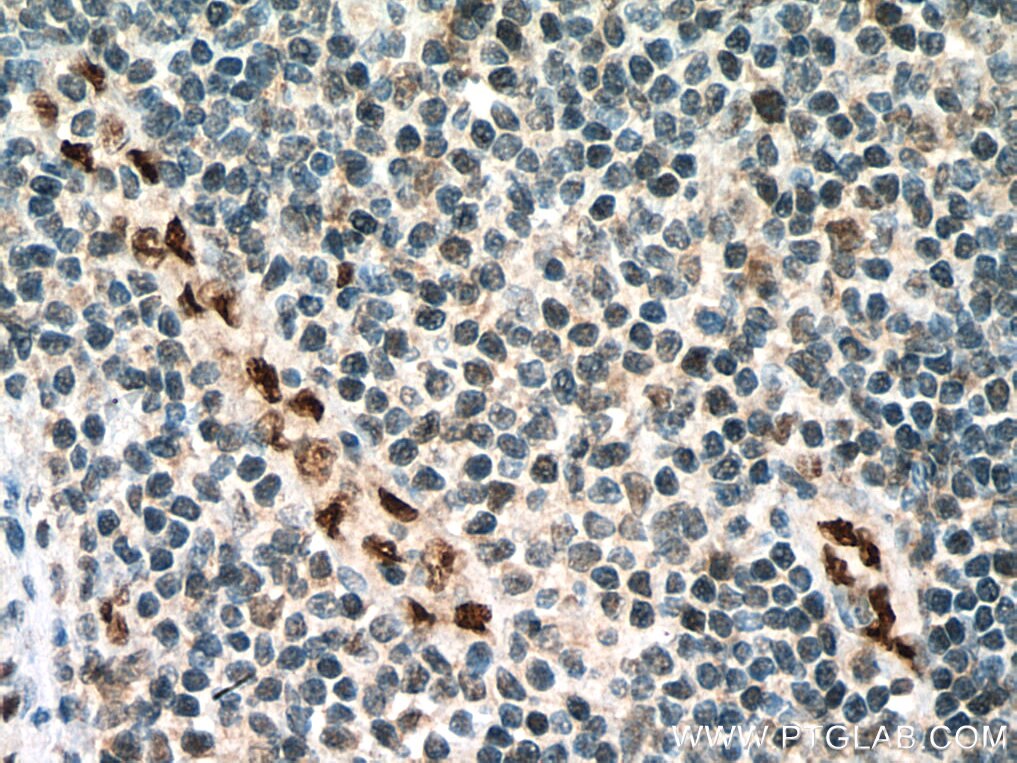 Immunohistochemistry (IHC) staining of human tonsillitis tissue using ERG Polyclonal antibody (14356-1-AP)