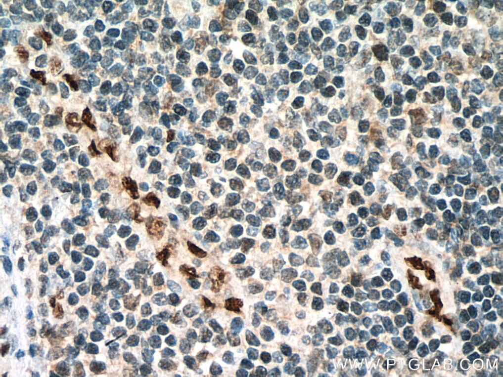 IHC staining of human tonsillitis using 14356-1-AP